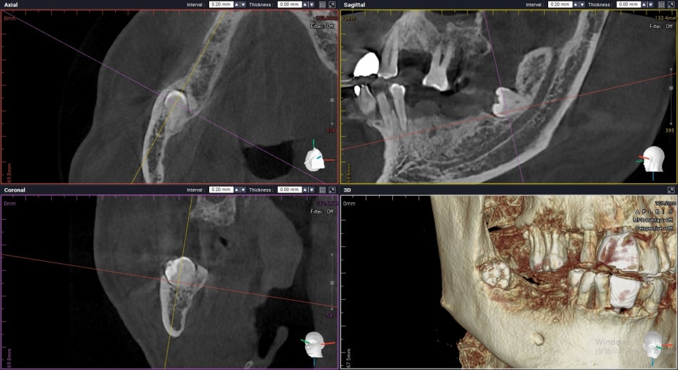 사랑니 3D-CT 진단 화면 — 단면 영상(Axial·Sagittal·Coronal)과 3D 재구성 영상으로 사랑니와 신경관의 위치 관계를 확인하는 모습